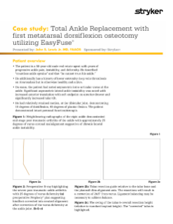 TAR with 1st metatarsal dorsiflexion osteotomy utilizing EasyFuse